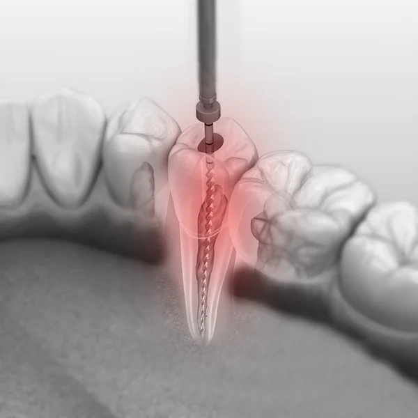 Orasore-Dental-Tablet-Root-Canal-Treatment